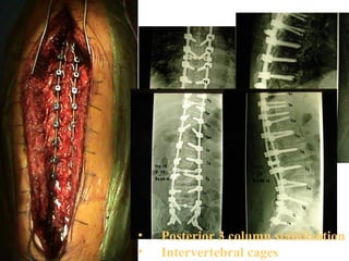 • Posterior 3 column stabilization
• Intervertebral cages
 