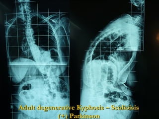 Adult degenerative Kyphosis – ScolioisisAdult degenerative Kyphosis – Scolioisis
(+) Parkinson(+) Parkinson
 