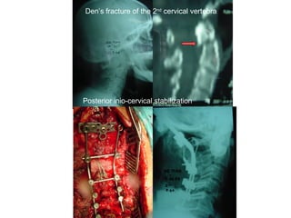 Den’s fracture of the 2nd
cervical vertebra
Posterior inio-cervical stabilization
 