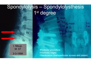 I. Μαυρ.
M. 57
3-3-1998
•Posterior procedure
•Interbody cages
•Stabilization (transpedicular screws and plates)
Spondylolysis – Spondylolysthesis
1st
degree
 