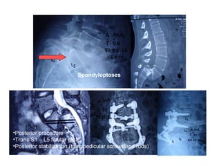 Spondyloptoses
•Posterior procedure
•Trans S1 – L5 fibular graft
•Posterior stabilization (transpedicular screws and rods)
 