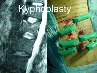 Kyphoplasty
 