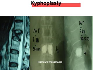 Kyphoplasty
kidney’s metastasis
 