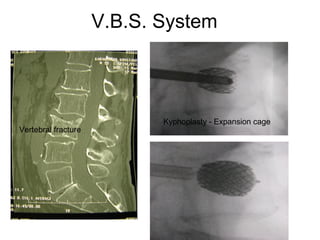V.B.S. System
Vertebral fracture
Kyphoplasty - Expansion cage
 