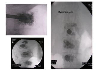 Kyphoplasties
 
