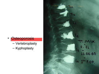 • Osteoporosis
– Vertebroplasty
– Kyphoplasty
 