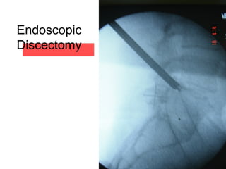 Endoscopic
Discectomy
 