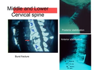 Middle and Lower
Cervical spine
Posterior stabilization
Anterior stabilization
Burst fracture
 