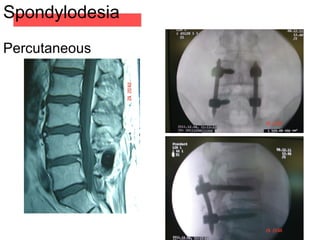 Spondylodesia
Percutaneous
 