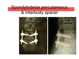Spondylodesia percutaneous
& Interbody spacer
 