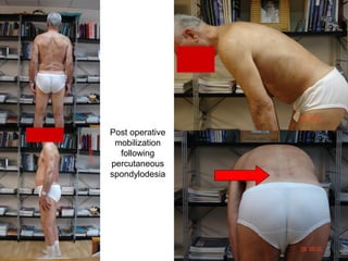 Post operative
mobilization
following
percutaneous
spondylodesia
 