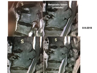 8-9-2018
Metastatic tumor
(prostate)
 