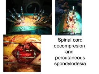 Spinal cord
decompresion
and
percutaneous
spondylodesia
 