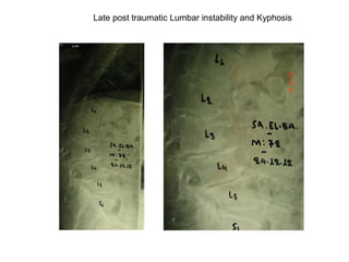 Late post traumatic Lumbar instability and Kyphosis
 