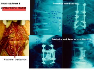 Thoracolumbar &
Lumbar Spinal Injuries
Posterior and Anterior stabilization
Posterior stabilization
Fracture - Dislocation
 