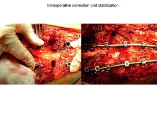 Intraoperative correction and stabilization
 