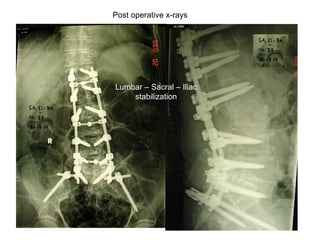 Post operative x-rays
Lumbar – Sacral – Iliac
stabilization
 
