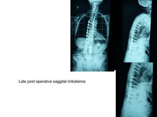 Late post operative saggital imbalance
 