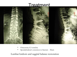 Treatment
• Osteotomy L3 vertebra
• Spondylodesia’s extension to Sacrum - Ilium
Lumbar lordosis and saggital balance restoration
 