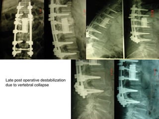Late post operative destabilization
due to vertebral collapse
 