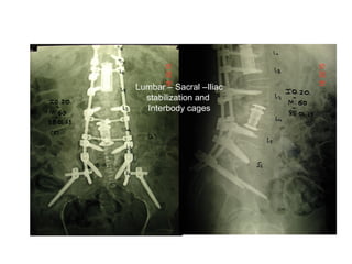 Lumbar – Sacral –Iliac
stabilization and
Interbody cages
 