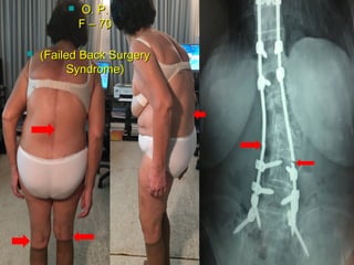  Ο. Ρ.Ο. Ρ.
F –F – 7070
 ((Failed Back SurgeryFailed Back Surgery
Syndrome)Syndrome)
 