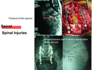 Sacral
Spinal Injuries
Fracture of the sacrum
Decompression and Posterior stabilization
of the sacrum
 