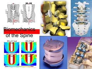 Biomechanics
of the Spine
Bonescrew
1st
load
step
2nd
load
step
Symmetry
axis
Threaded
holeScrew
hosting
material
Symmetry
axis
Screw
hosting
material
Bonescrew
50% of 1st
load
step
50% 2nd
load
step
100% of 1st
load
step
100% 2nd
load
step
 