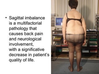 • Sagittal imbalance
is a multifactorial
pathology that
causes back pain
and neurological
involvement,
with a significative
decrease in patient’s
quality of life.
 