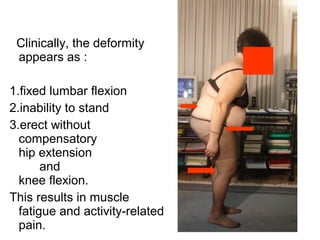 Clinically, the deformity
appears as :
1.fixed lumbar flexion
2.inability to stand
3.erect without
compensatory
hip extension
and
knee flexion.
This results in muscle
fatigue and activity-related
pain.
 