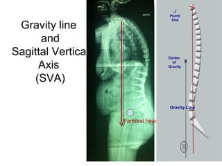 Gravity line
and
Sagittal Vertical
Axis
(SVA)
Femoral head
S1 Gravity Line
Center
of
Gravity
C7
Plumb
SVA
 