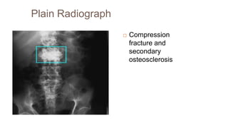 Plain Radiograph
 Compression
fracture and
secondary
osteosclerosis
 