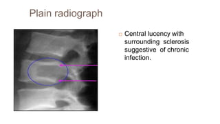 Plain radiograph
 Central lucency with
surrounding sclerosis
suggestive of chronic
infection.
 