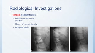 Radiological Investigations
• Healing is indicated by
– Decreased soft tissue
shadow
– Return of normal density
– Bony ankylosis
 