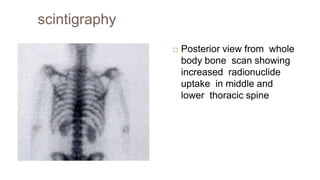 scintigraphy
 Posterior view from whole
body bone scan showing
increased radionuclide
uptake in middle and
lower thoracic spine
 
