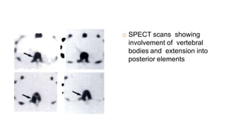  SPECT scans showing
involvement of vertebral
bodies and extension into
posterior elements
 