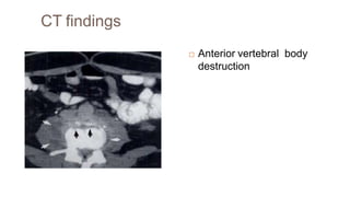 CT findings
 Anterior vertebral body
destruction
 