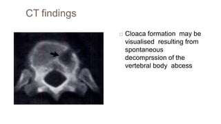 CT findings
 Cloaca formation may be
visualised resulting from
spontaneous
decomprssion of the
vertebral body abcess
 