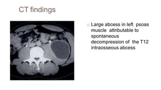 CT findings
 Large abcess in left psoas
muscle attributable to
spontaneous
decompression of the T12
intraosseous abcess
 