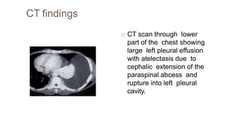 CT findings
 CT scan through lower
part of the chest showing
large left pleural effusion
with atelectasis due to
cephalic extension of the
paraspinal abcess and
rupture into left pleural
cavity.
 