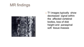 MR findings
 T1 images typically show
decreased signal within
the affected vertebral
bodies, loss of disk
height and paraspinal
soft tissue masses
 