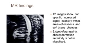 MR findings
 T2 images show non
specific increased
signal intensity within
areas of osseous and
soft tissue changes.
 Extent of paraspinal
abcess formation
anteriorly is better
visualised.
 