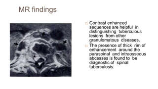 MR findings
 Contrast enhanced
sequences are helpful in
distinguishing tuberculous
lesions from other
granulomatous diseases.
 The presence of thick rim of
enhancement around the
paraspinal and intraosseous
abcesses is found to be
diagnostic of spinal
tuberculosis.
 