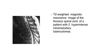  T2-weighted magnetic
resonance image of the
thoracic spinal cord of a
patient with 2 hyperintense
intramedullary
tuberculomas.
 