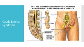 Cauda Equina
Syndrome
 