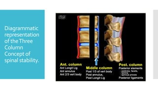 Diagrammatic
representation
of theThree
Column
Concept of
spinal stability.
 
