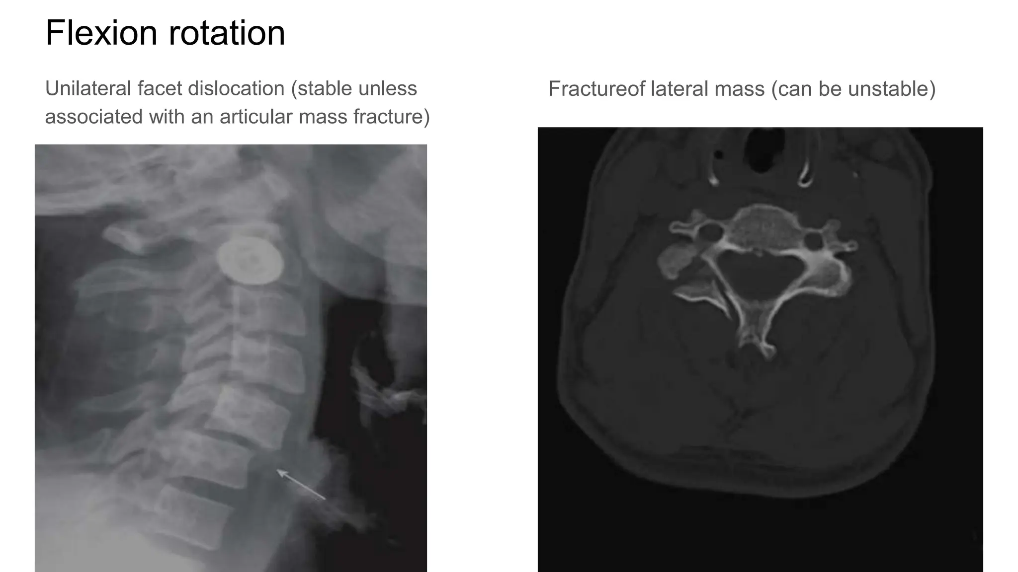 SPINAL TRAUMA ITS ANATOMY AND EMERGENCY MANAGEMENT OF | PPTX