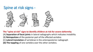 Toppling Sign Spinal Tuberculosis: Current Concepts Dr. rajasekaran | PPTX