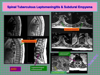 Spinal Tuberculous Leptomeningitis & Subdural EmpyemaSpinal Tuberculous Leptomeningitis & Subdural Empyema
MRIMRI
Subdural empyema
Subdural empyema
Leptomeningeal
enhancement
Leptomeningeal
enhancement
Lung cavitated nodules
 