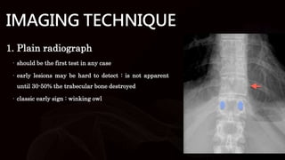 Spinal Tumor.pptx